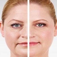 بعد از تزریق بوتاکس، اثر آن چه زمانی مشخص می شود؟
