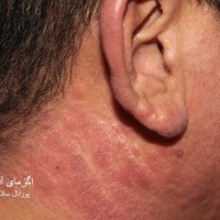 عکس اگزمای مزمن ناشی ازآفتاب