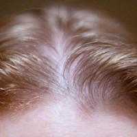 درمان ریزش موی هورمونی ژنتیکی زنانه چیست؟