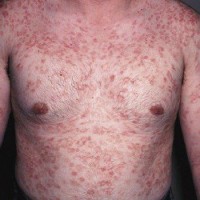 بیماری سیفلیس (Syphilis) چیست؟