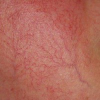 تلانژکتازی یا گشادی مویرگی و درمان آن