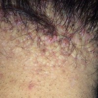 پشت گردنم دچار آکنه کلوییدالیس شده است. آیا راه درمانی دارد؟