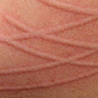 علل کهیر فیزیکی  و درمان آن
