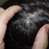علت ریزش  مو و خارش کف سرم چیست؟