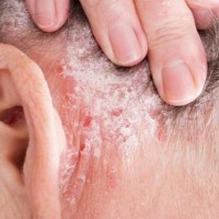 دخترم مدتی هست گرفتار بیماری پسوریازیس شده آیا این بیماری درمان دارد؟