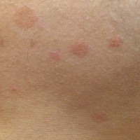 لکه های قرمز روی بدنم نشانه چیست؟