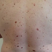 چه نوع خالهای رنگی (ملانوسيتی) را بايد جدی گرفت و جهت تشخيص دقيق تر به متخصص پوست مراجعه نمود؟   
