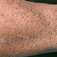 روش های درمان خشکی پوست 