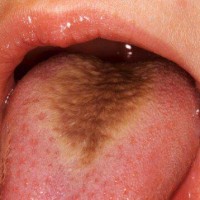 درمورد زبان مودار(Hairy tongue) چه می دانید؟