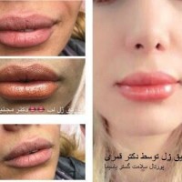 انواع فيلر و تاثیرات آن در زیبایی