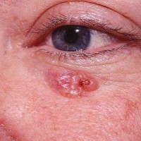 سرطان سلول های قاعده ای پوست (Basal Cell Carcinoma)