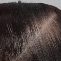 علت ریزش و نازک شدن موهایم چیست و چه روش درمانی برای آن وجود دارد؟