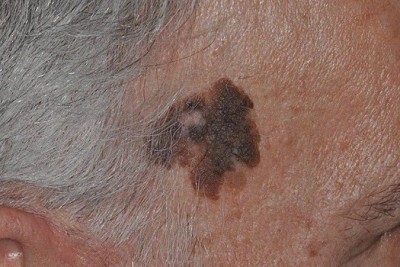 کراتوز سبورئیک (Seborrheic Keratosis) 