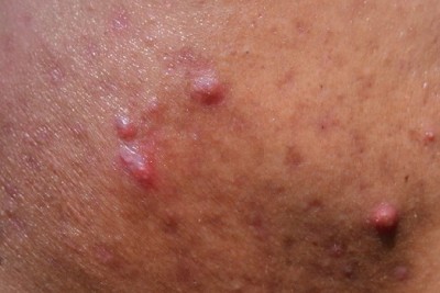 جوش های زیر پوستی قرمز روی صورتم چه دلیلی میتواند داشته باشد و چه درمانی دارد؟