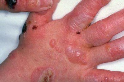 اپیدرمولیزیس بولوزا (Epidermolysis Bullosa) یا بیماری پروانه ای