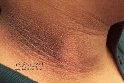 بیماری آکانتوزیس نگریکان (Acanthosis Nigricans)