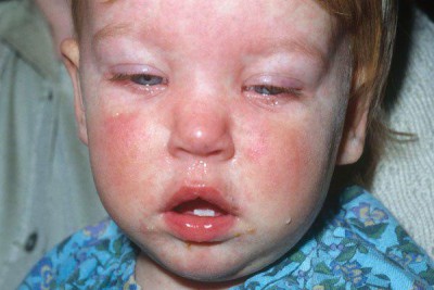 سرخک (Measles)