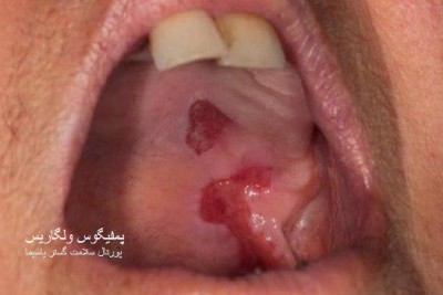 بیماری پمفیگوس (Pemphigus) و راههای درمان آن