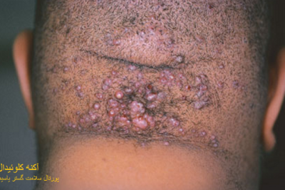 عکس آکنه کلوئیدال  (Acne keloidalis)