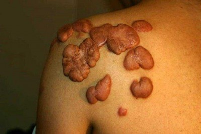 كلوييد (Keloid)