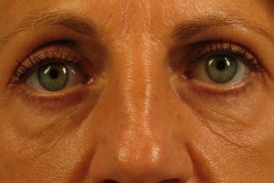 روش درمان جوش های روی كمر و گودی زير چشم چیست؟