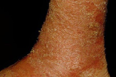 بیماری اگزمای ناشی از استاز وریدی (Stasis Dermatitis)