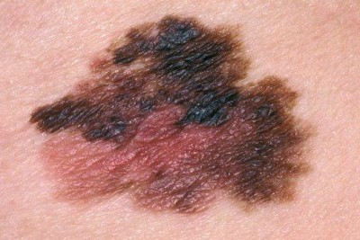 آشنایی با تومور بدخیم ملانوم (Melanoma)