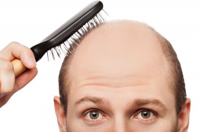 نکاتی  در مورد ریزش موی هورمونی- ارثی (آندروژنتیک)