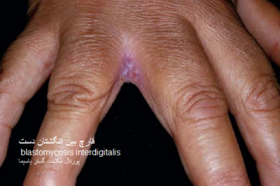 عکس عفونت قارچی بین انگشتان دست