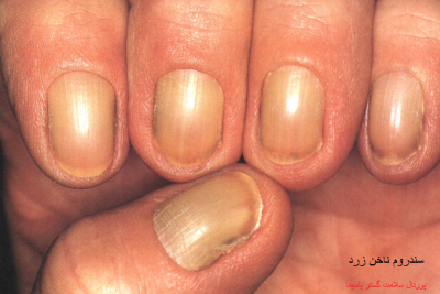عکس سندروم ناخن زرد(Yellow nail syndrome)