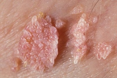 زگیل تناسلی (genital wart) و راههای درمان آن