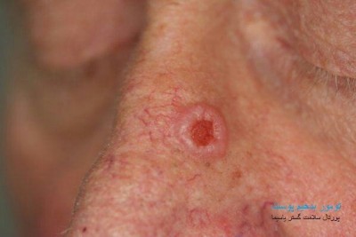 از تومورهای بدخیم پوست (skin cancer) بیشتر بدانیم