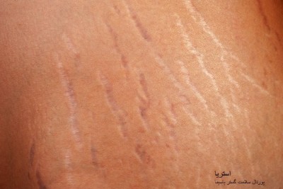 استریا یا ترکهای پوستی (stretch mark)