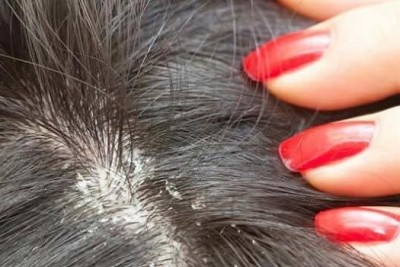 راه درمان ریزش مو و شوره سر چیست؟