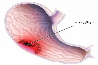 کشف روش جدید غربالگری بیماری سرطان معده