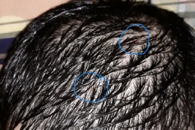 علت خارش و ریزش شدید موهای سر من چیست؟