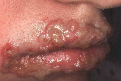  بیماری تبخال (herpes simplex) و راههای درمان آن