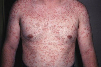 بیماری سیفلیس (Syphilis) چیست؟