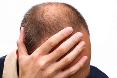 تجویز بیوتین در درمان ریزش موی سکه ای 