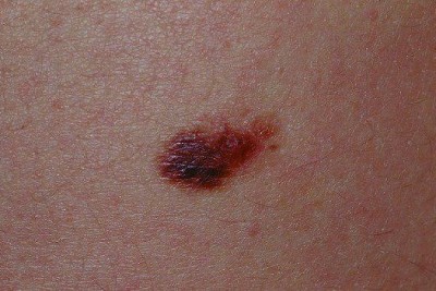 خال دیسپلاستیک (Dysplastic Nevus)