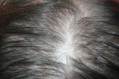 آیا کاشت مو برای من مناسب است و راه حل پرپشت شدن موهای من چه می باشد؟