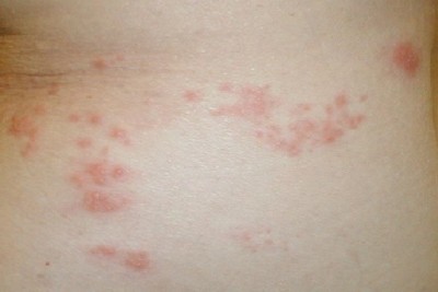 هر آنچه درباره بیماری پوستی  زونا (shingles) باید بدانیم