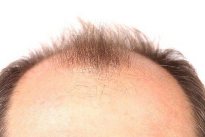 ریزش موی هورمونی ژنتیکی