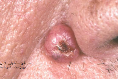عکس سرطان سلولهای بازال(قاعده ای)