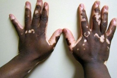 بیماری پیسی یا ویتیلیگو (Vitiligo)