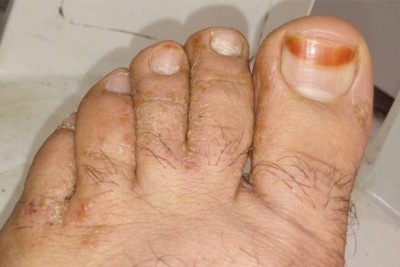 علت خارش شدید و پوسته شدن بین انگشتان پای من چیست؟