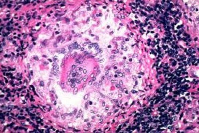 بیماری گرانولوم مغبنی (Granuloma inguinale) چیست؟