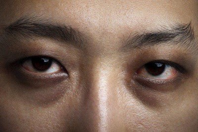 علل سیاهی دور چشم و درمان آن چیست؟