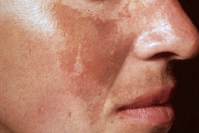 لک های تیره مقاوم به درمان روی بینی و گونه چگونه درمان میشوند؟