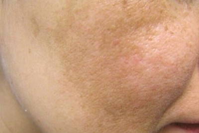 لکه های روی پوست صورت که بعد از زایمان ایجاد میشوند چگونه درمان می یابند؟